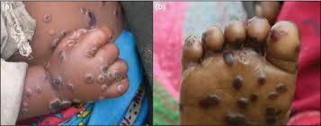 Monkeypox