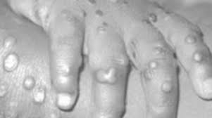 Monkeypox | Netherlands | PDF | PPT| Case Reports | Symptoms | Treatment