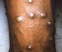 Monkeypox | United States| PDF | PPT| Case Reports | Symptoms | Treatment