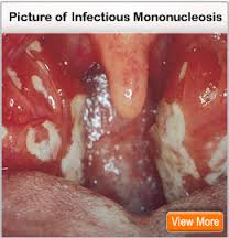 mono tonsils