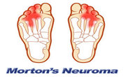 Mortons neuroma