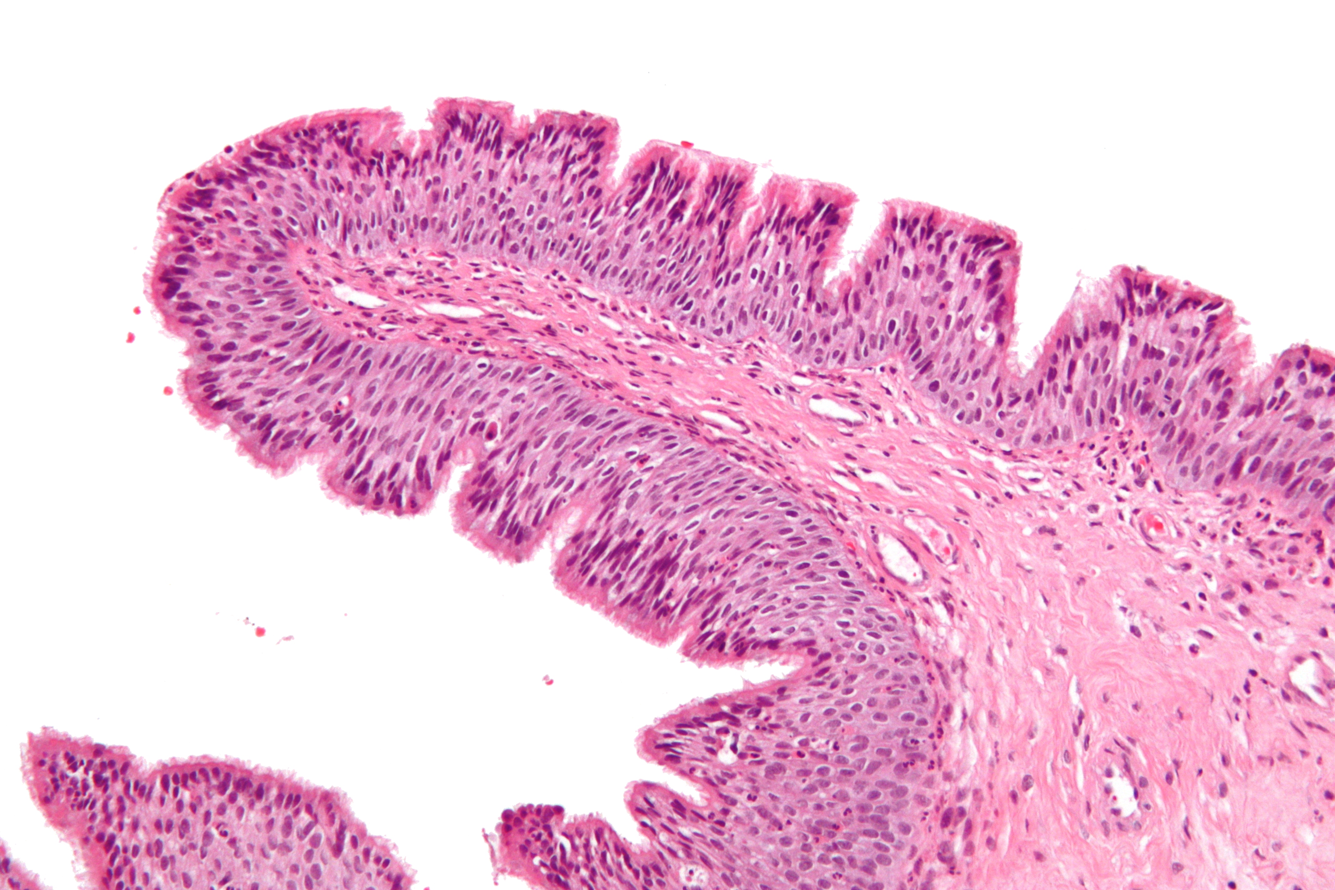 intranasal polyps