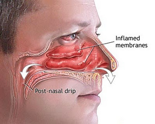 polyps in nasal cavity