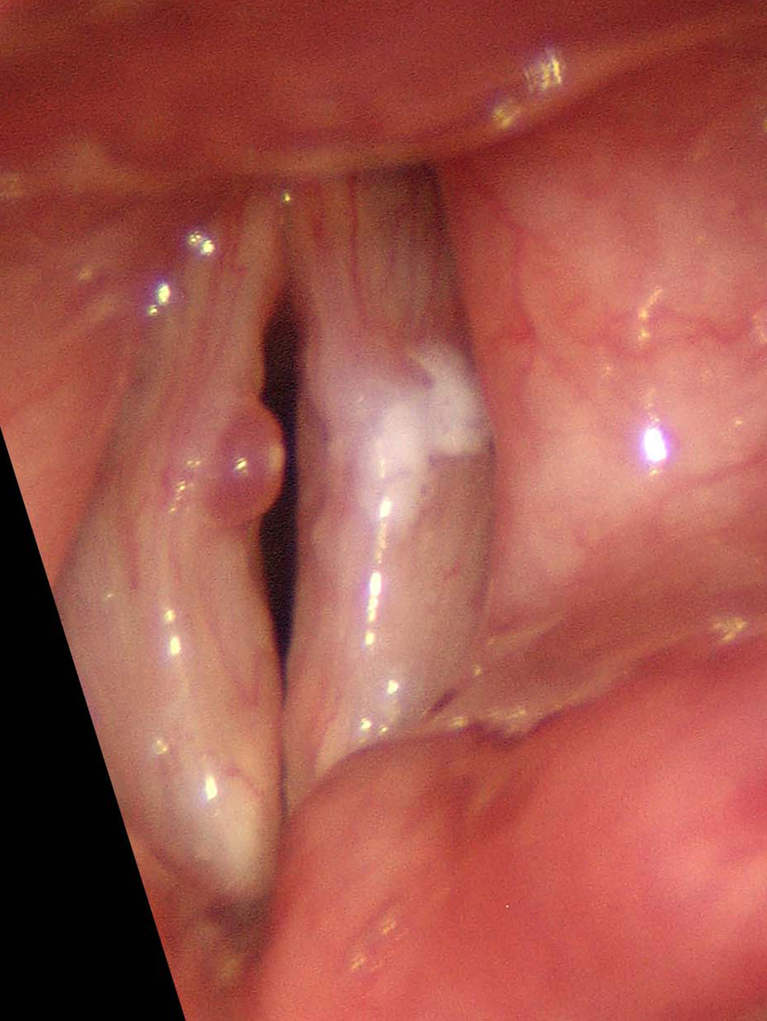 nasal polyps cough