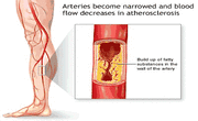 Peripheral Artery Disease