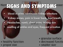 Polycystic Kidney Disease Singapore Pdf Ppt Case Reports Symptoms Treatment