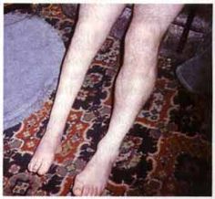 Post-polio syndrome