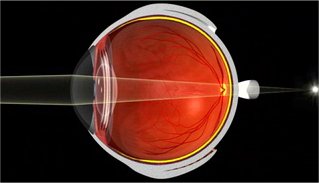 Presbyopia