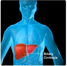 biliary cirrhosis pathophysiology