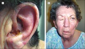  Ramsay Hunt syndrome Argentina PDF PPT Case Reports 