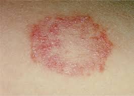 Ringworm (Body) | Germany| PDF | PPT| Case Reports | Symptoms | Treatment