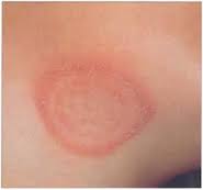 Ringworm (Body) | Germany| PDF | PPT| Case Reports | Symptoms | Treatment