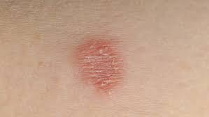 Ringworm (Body) | France| PDF | PPT| Case Reports | Symptoms | Treatment