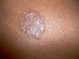 Ringworm (Body)