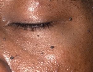 keratosis seborrheic skin keratoses leser light cancer ppt seborrhoeic benign treatment lesions sign small articles wart abdominal