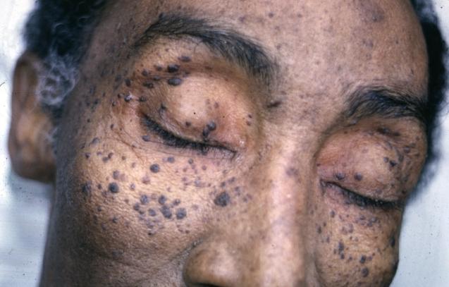 malaysia treatment skin Case  Switzerland PPT  keratosis Seborrheic   PDF