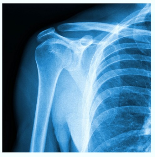 Separated Shoulder   Separated Shoulder 45989 