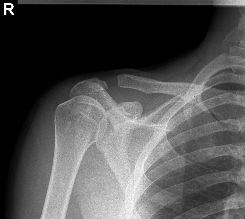 What Is A Separated Shoulder Injury