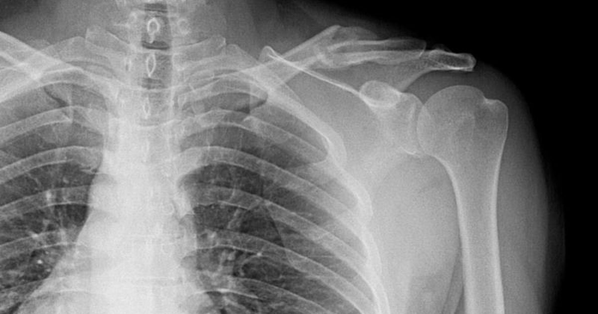 Separated Shoulder   Separated Shoulder 46106 