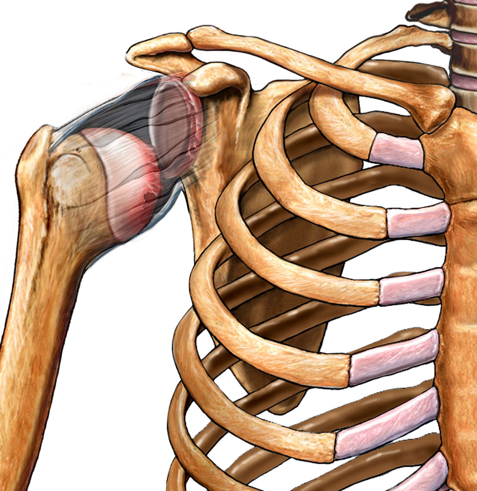 Separated Shoulder   Separated Shoulder 46167 