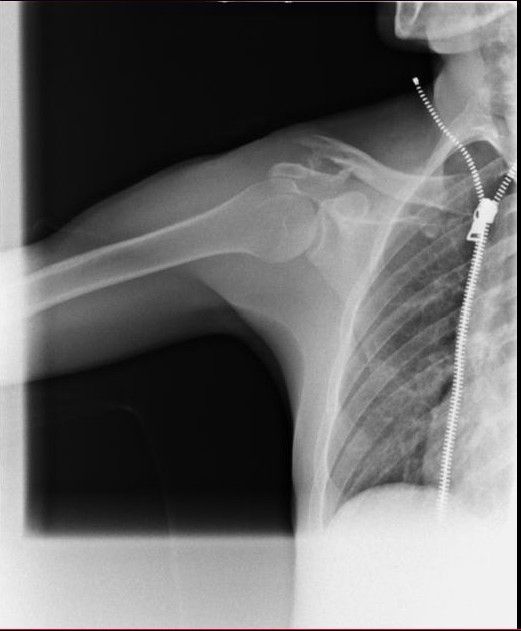 separated-shoulder