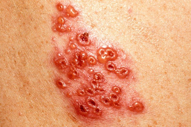 Shingles Vaccine | Germany| PDF | PPT| Case Reports | Symptoms | Treatment