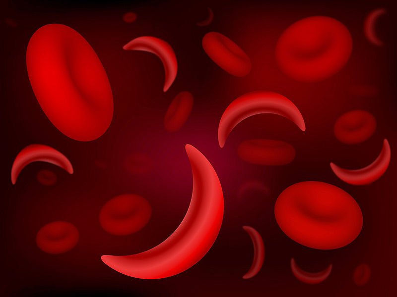 Sickle Cell Anemia