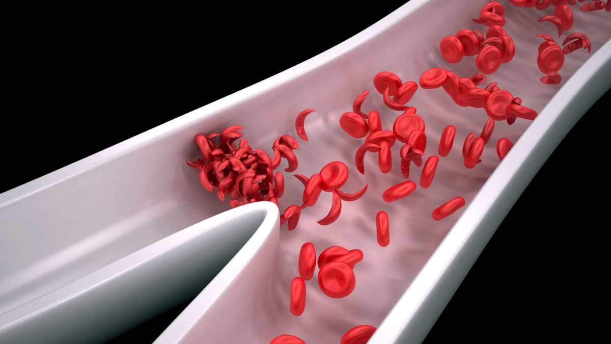 sickle-cell-disease