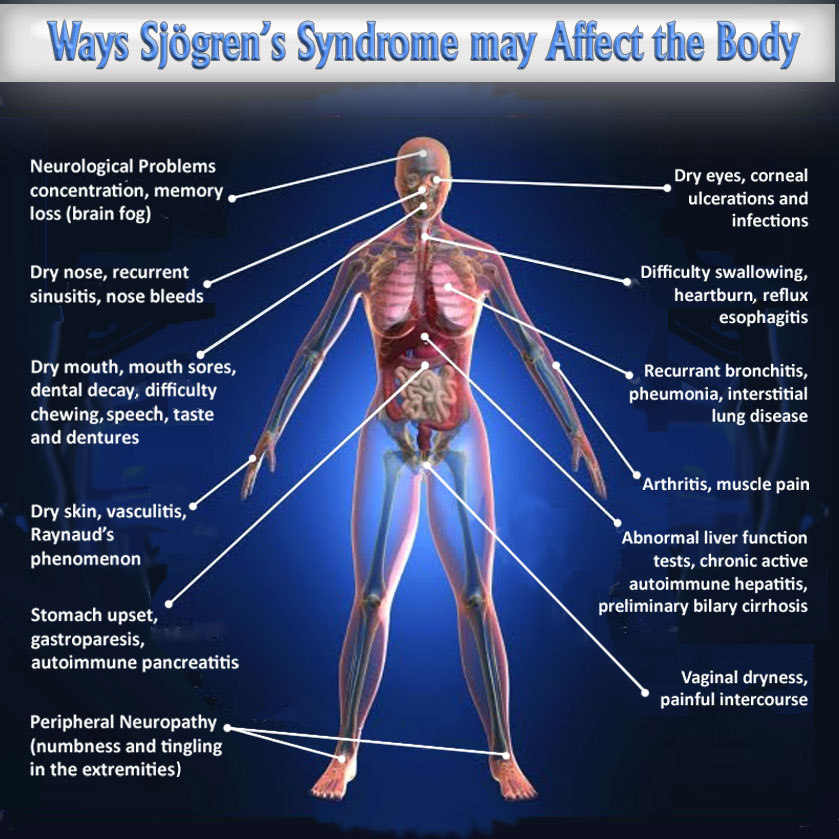 sjogren