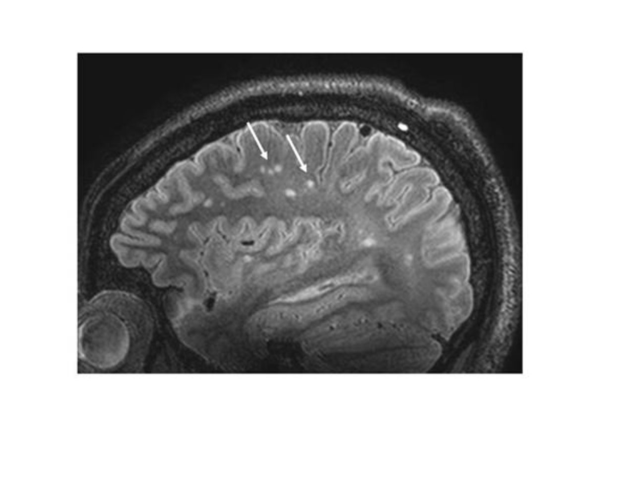 Small vessel disease