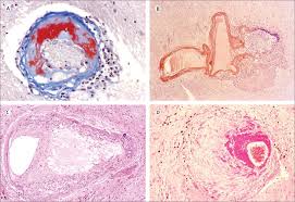 Small vessel disease