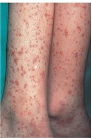 Small vessel disease