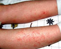 Smallpox | Norway| PDF | PPT| Case Reports | Symptoms | Treatment