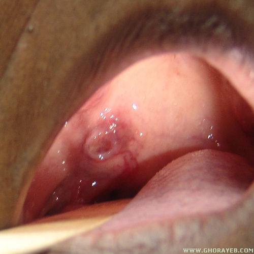 Soft Palate Cancer | China| PDF | PPT| Case Reports | Symptoms | Treatment