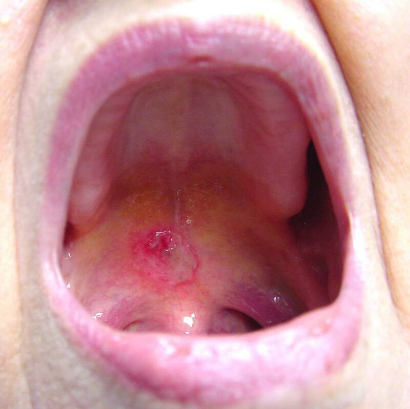 soft-palate-cancer-singapore-pdf-ppt-case-reports-symptoms