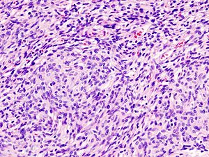 Solitary Fibrous Tumors(SFT)