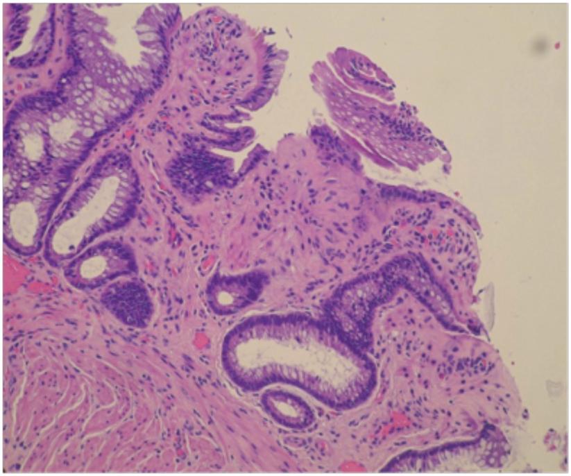 Solitary Rectal Ulcer Syndrome 4838