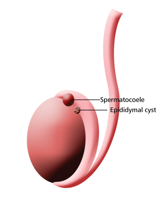 Spermatocele | UK| PDF | PPT| Case Reports | Symptoms | Treatment