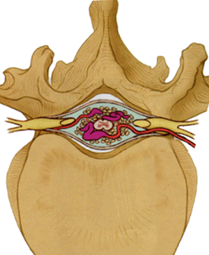 Spinal Vascular Malformations The Neurosurgical Atlas By Aaron Cohen