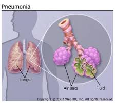 Streptococcus pneumonia infection | United States| PDF | PPT| Case ...