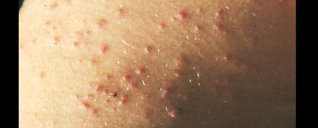 pictures of swimmers itch rash