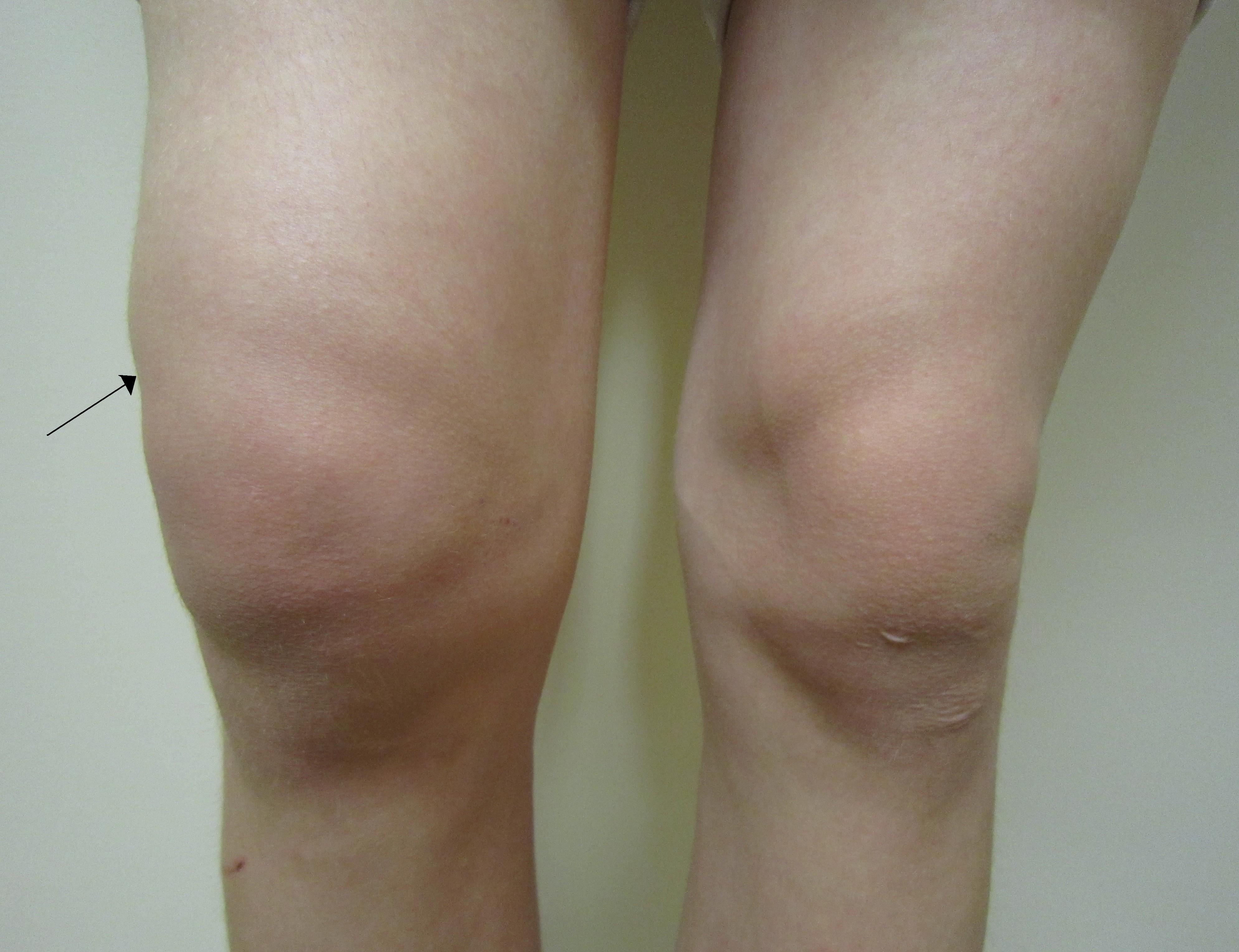 Swollen Knee