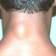 lymph node back of neck swollen