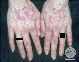 Systemic lupus erythematosus | Russia | PDF | PPT| Case Reports ...