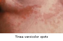 Tinea versicolor