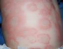 Urticaria