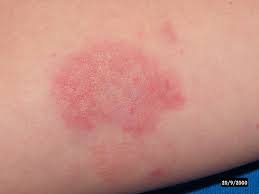 Vasculitis | Japan| PDF | PPT| Case Reports | Symptoms | Treatment