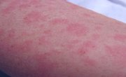 West Nile virus Infection | China| PDF | PPT| Case Reports | Symptoms ...